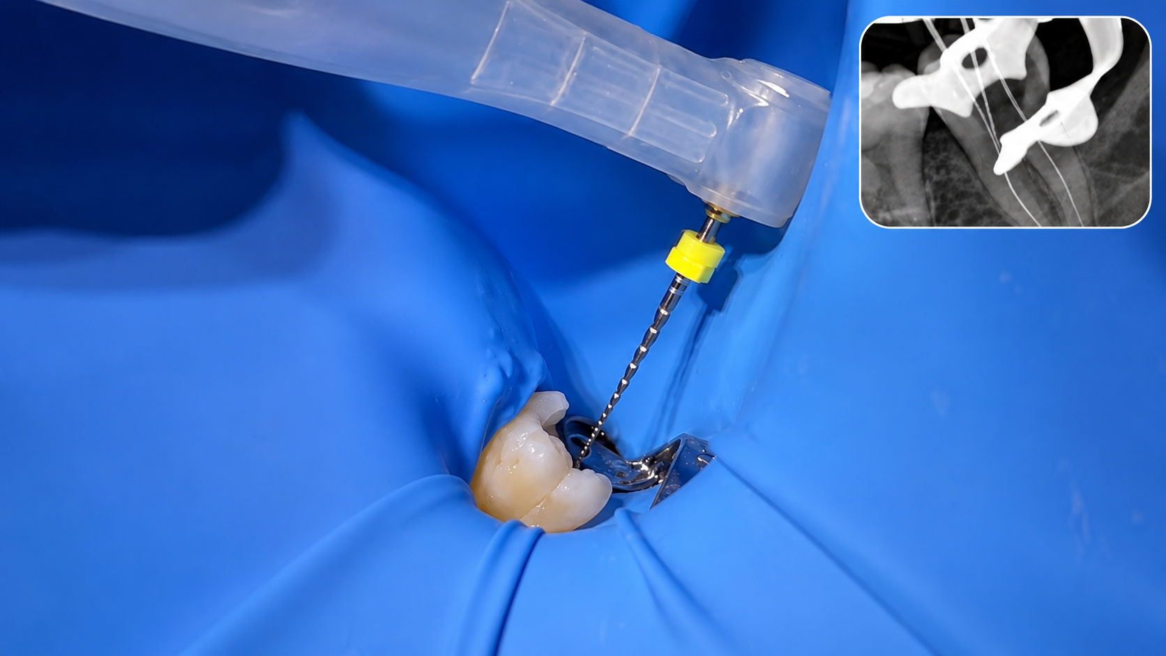 Endodoncia