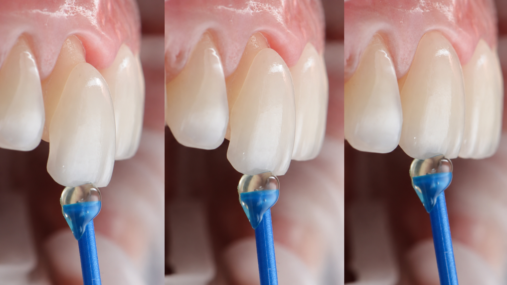 Estética Dental