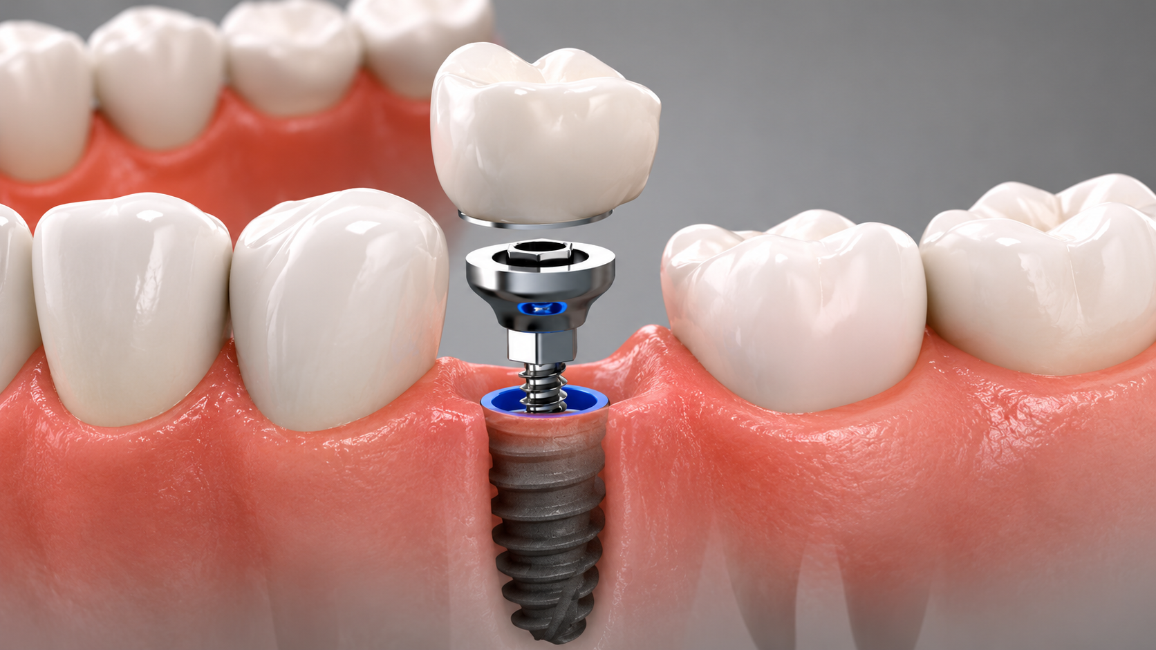 Implantes dentales