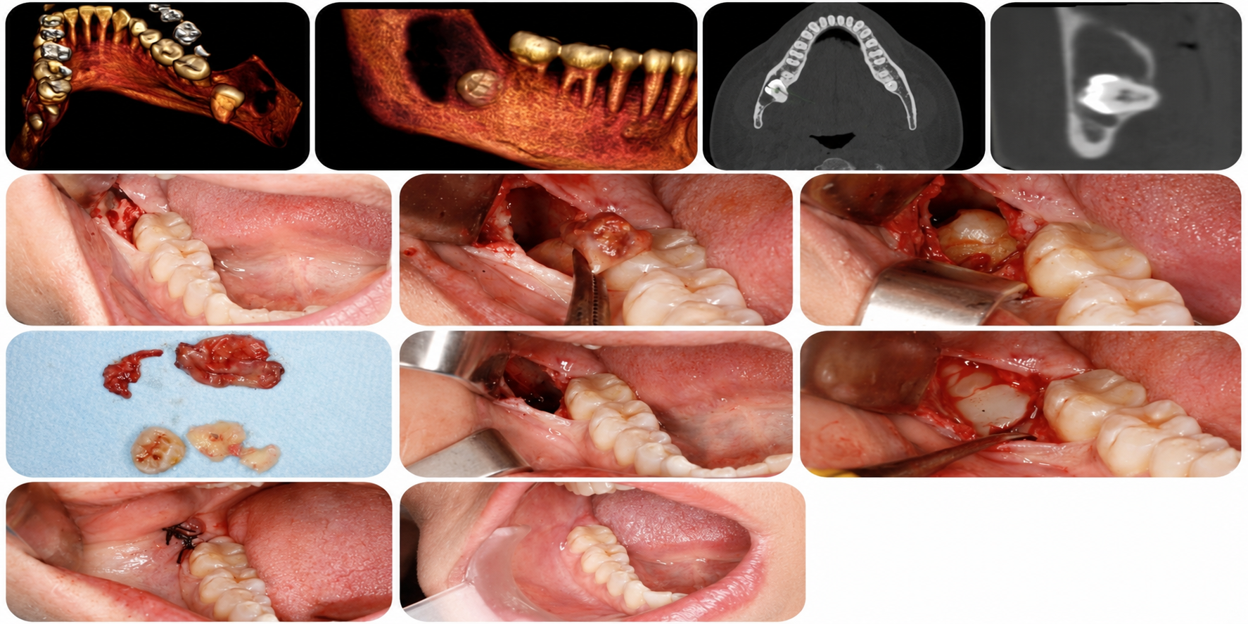 Cirugia Oral y MaxiloFascial